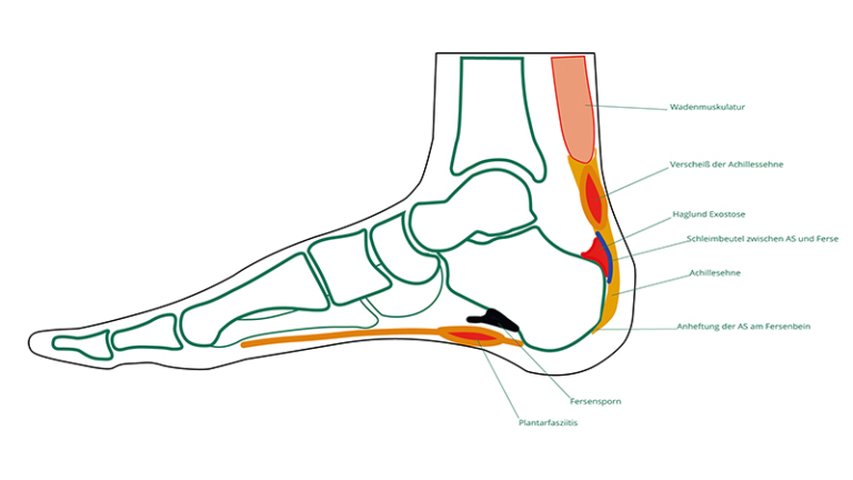 Haglund-Exostose – OGAM Orthopädie