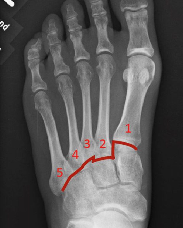lisfranc-arthrodese-ogam-orthop-die