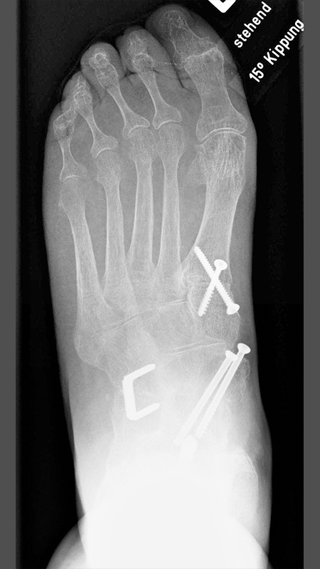 Roentgenbild-Triple-Arthrodese-oben
