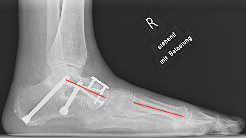 doubel-arthrodese-roentgenbild-nachop-seite