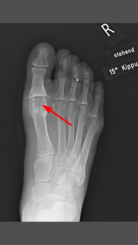 hallux-rigidus-cartiva-roentgenbild-implantat