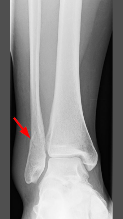 Weber B Fraktur Wann Wieder Auto Fahren Sprunggelenkfraktur - OGAM Orthopädie