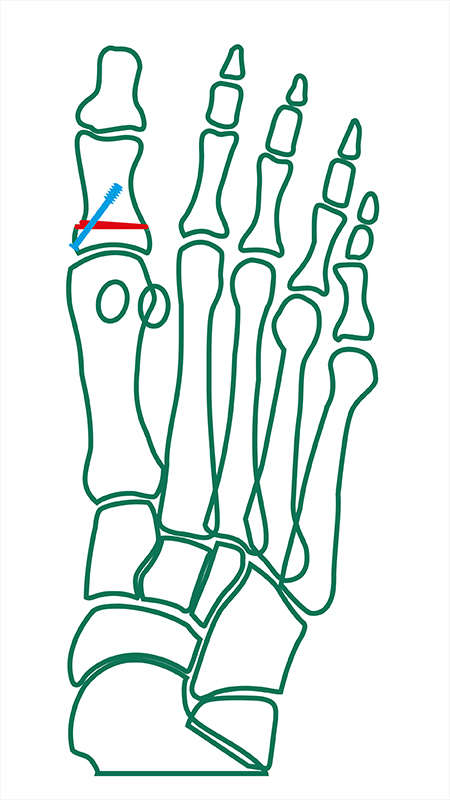 Akin-Osteotomie Grafik