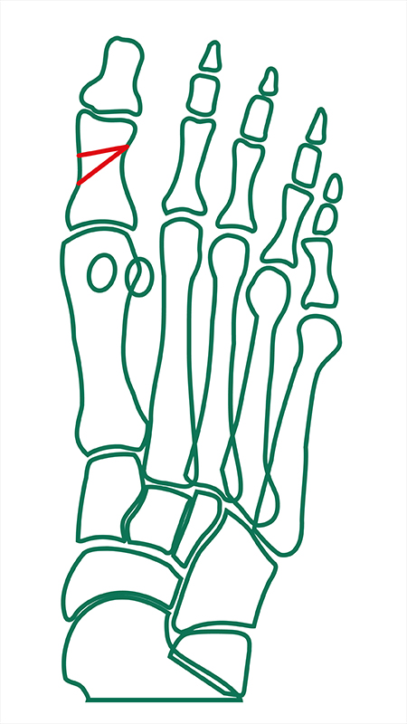 Distale Akin-Osteotomie