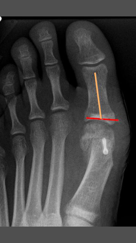 Hallux valgus interphalangeus-reontgenbild-markiert