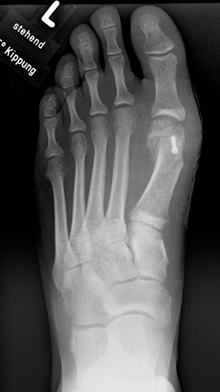 Hallux valgus interphalangeus-reontgenbild