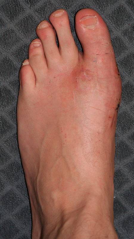 Hallux valgus interphalangeus