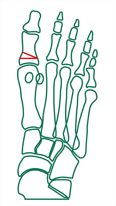 Keilförmige Osteotomie