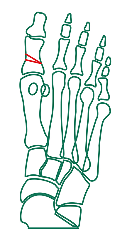 Proximale Akin-Osteotomie