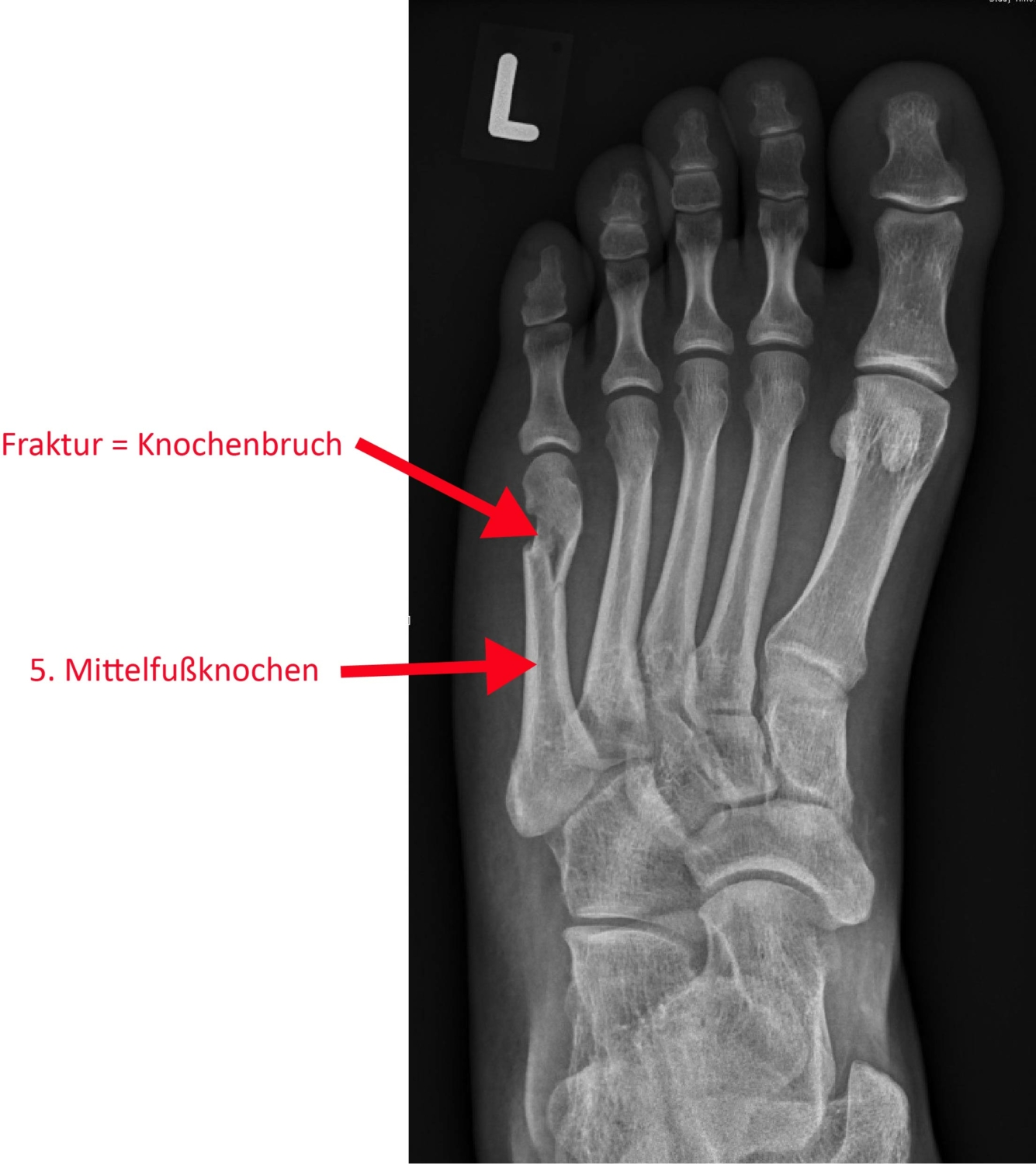 Fraktur 5. Mittelfußknochen OGAM Orthopädie