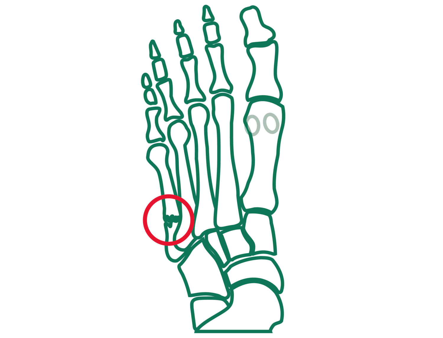 Schwellneigung des Fußes nach OP OGAM Orthopädie